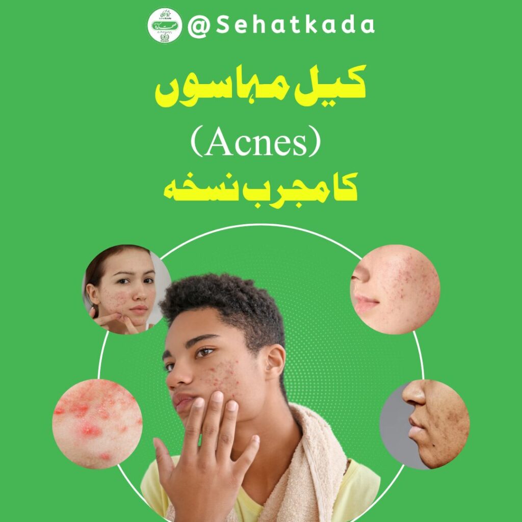 کیل مہاسوں کا علاج | Herbal Acne Treatment | Keel Mahason ka Ilaj | Pimples Natural Cure