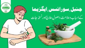 Psoriasis (Chambal / Eczema) Treatment – Asbab, Alamat & Desi Nuskhe in Tib e Unani
